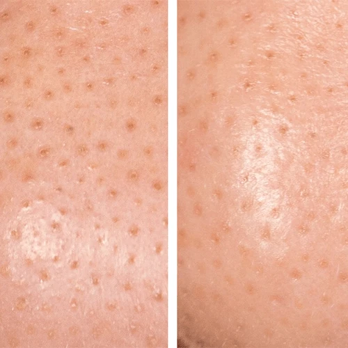 HydroPeptide Bambusa Blackhead Banisher Pore Perfecting Nose Mask 7 HydroPeptide Bambusa Blackhead Banisher Pore Perfecting Nose Mask - Image 7